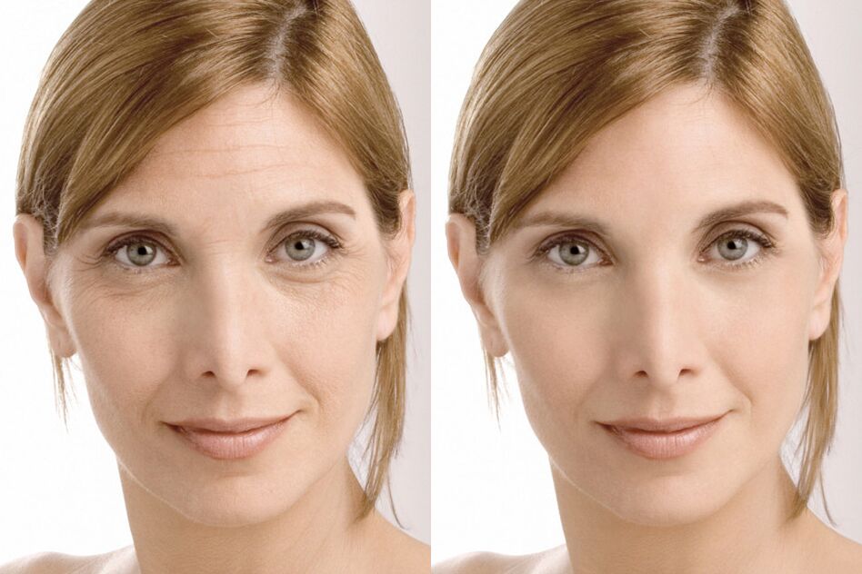 Expérience d'utilisation avant et après l'utilisation de la crème intenskin de Milana