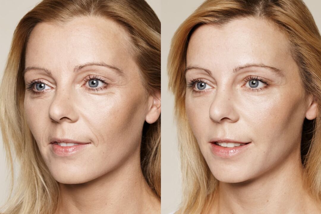 Expérience d'utilisation avant et après l'utilisation de la crème intenskin de Valeria